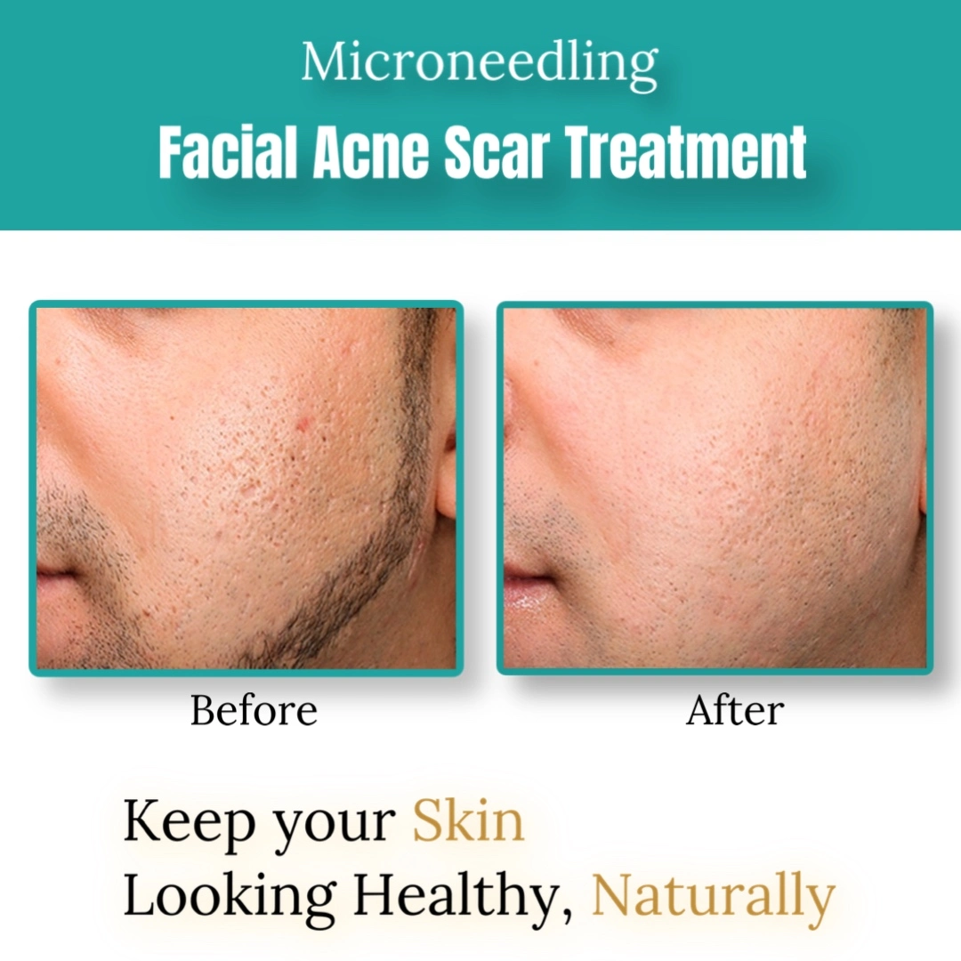 microneedling-2